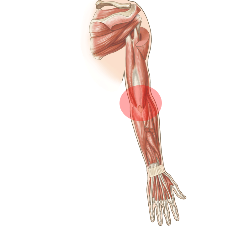 左腕の筋肉の構造と肘の痛めている画像