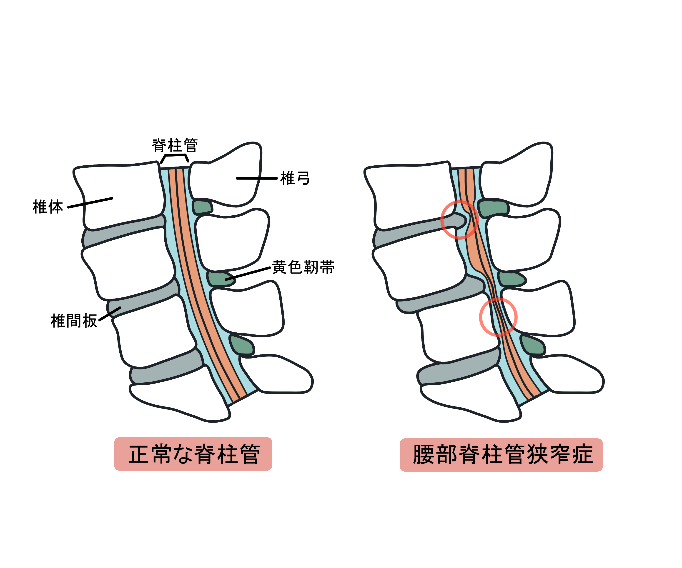 正常な脊柱と脊柱管狭窄症を起こしている背骨の画像