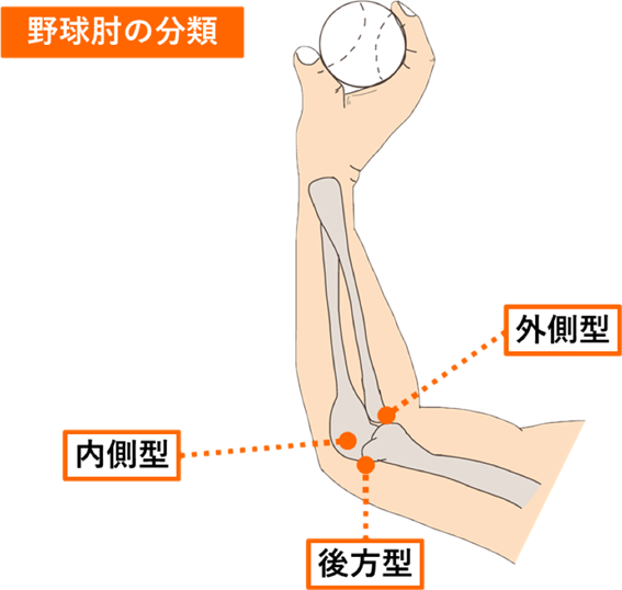 野球肘の分類の説明で橈骨頭部を痛めると外側型、尺骨部を痛めると内側型、上腕骨部を痛めると後方型の図