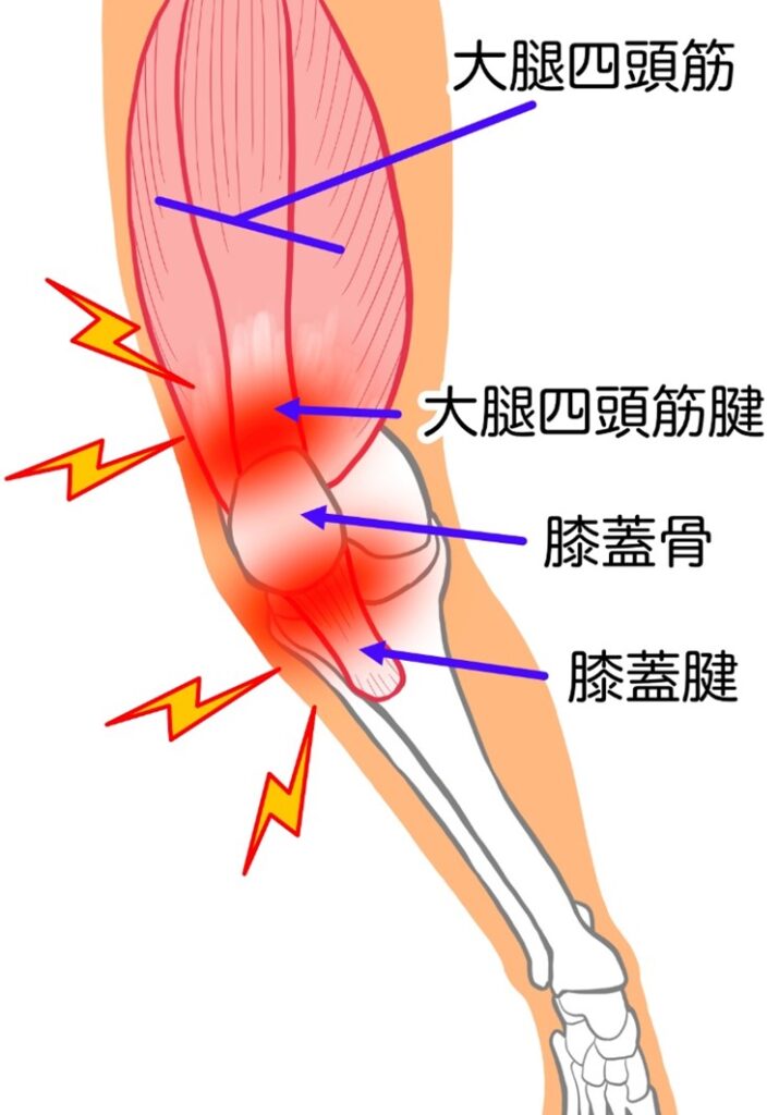 大腿四頭筋の膝側の付着部の大腿四頭筋腱部の炎症と膝蓋腱に炎症が起きている画像