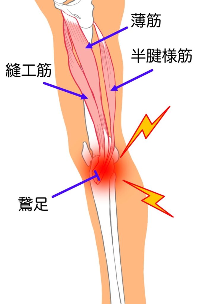 薄筋、縫工筋、半腱様筋で構成する鵞足を示し炎症が起きている画像
