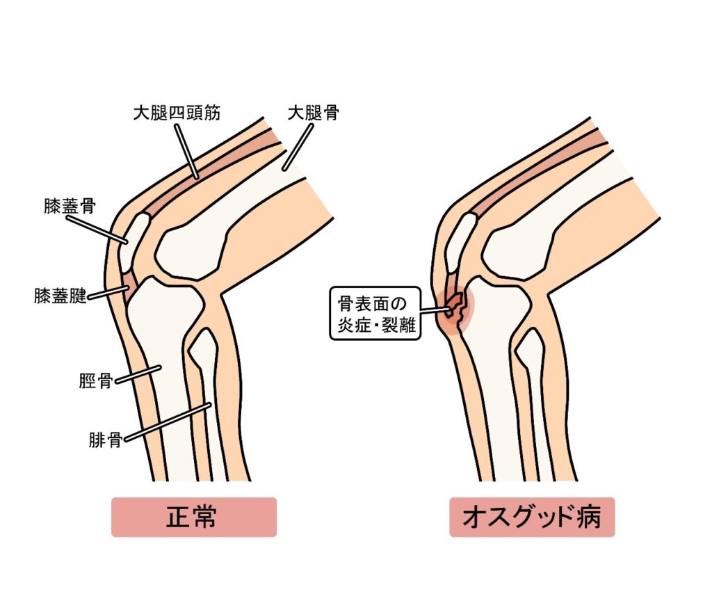 正常な膝とオスグッド病を見比べ炎症と裂離がどこに発生するかを示した画像