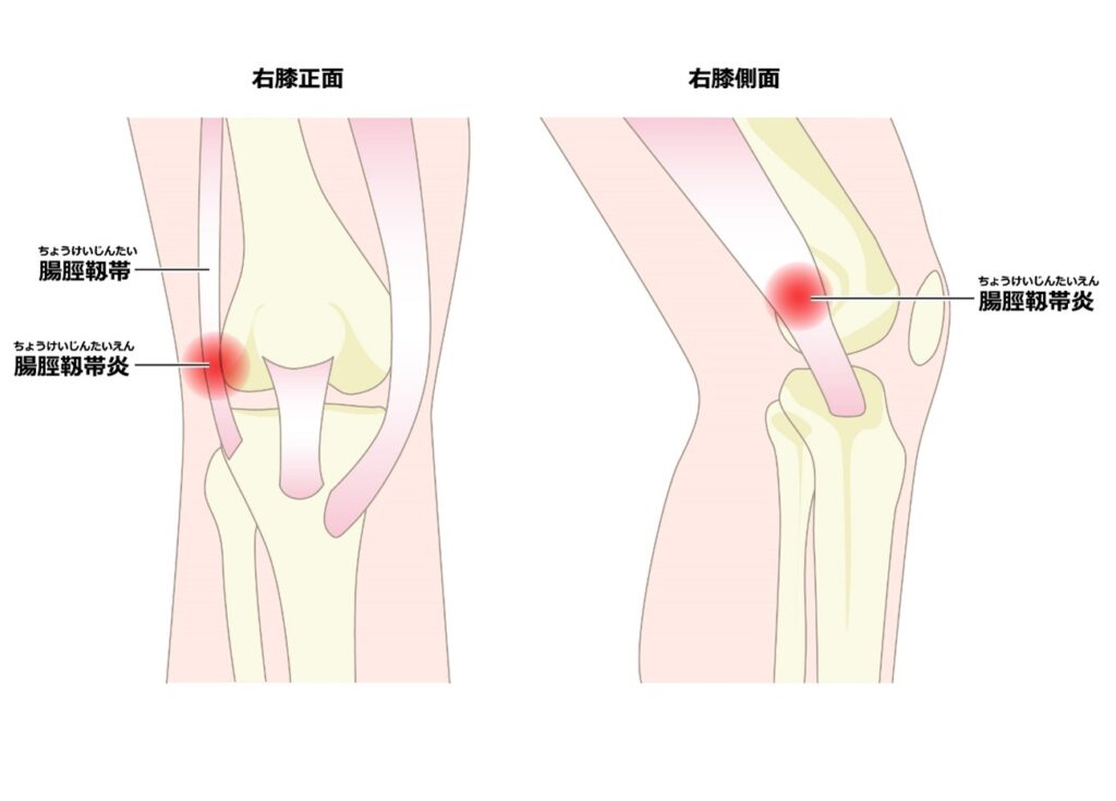 膝の腸脛靭帯がどこにありどの箇所が炎症を起こすか示した画像