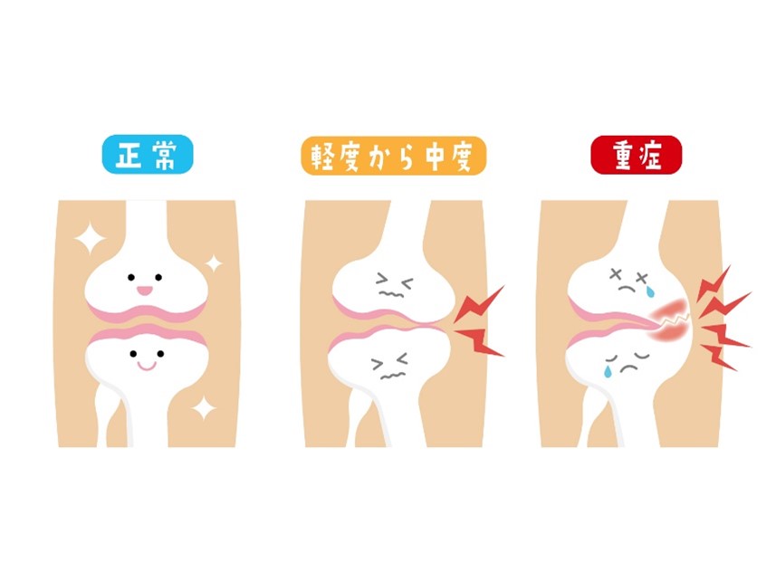 変形性膝関節症の説明の絵