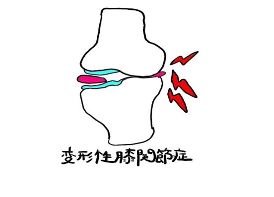 変形性膝関節症の絵
