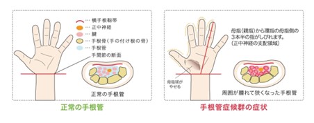 手根管症候群の説明のイラスト