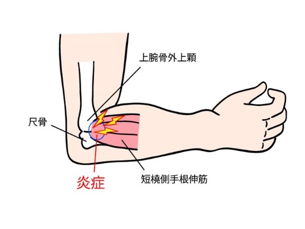 外側上顆炎のイラスト