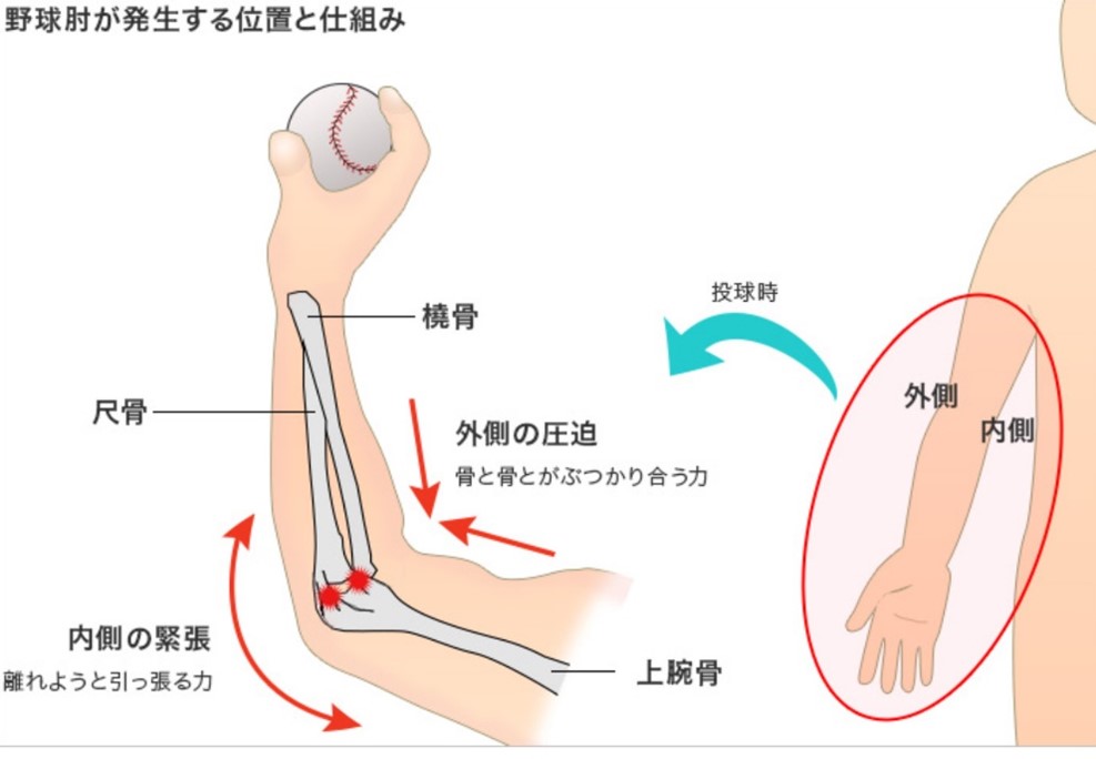 野球肘のイラスト