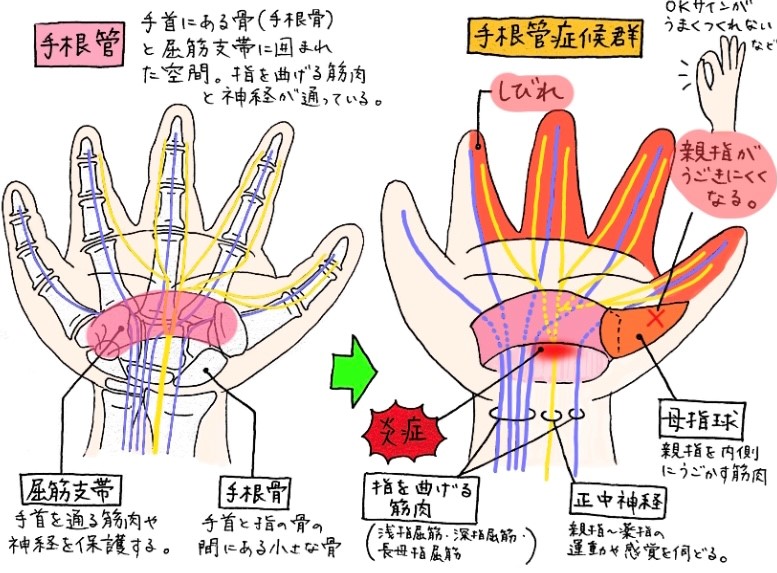 手根管症候群のイラスト