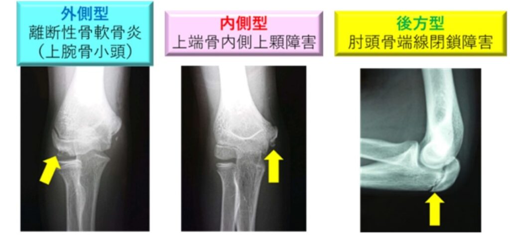 野球肘の分類